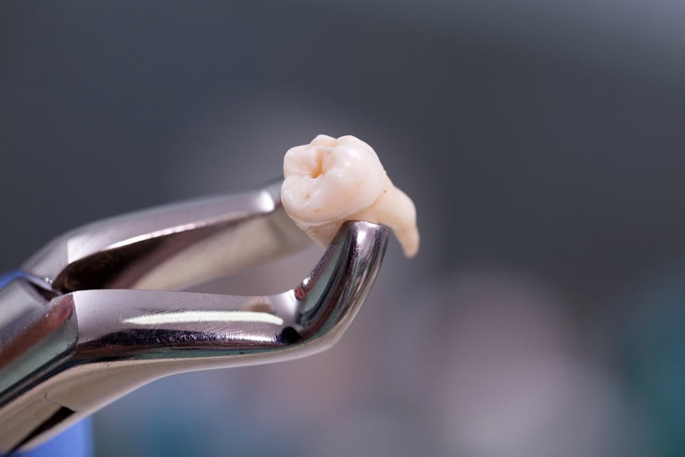 Is It Better To Extract an Unhealthy Tooth or To Try To Save It?