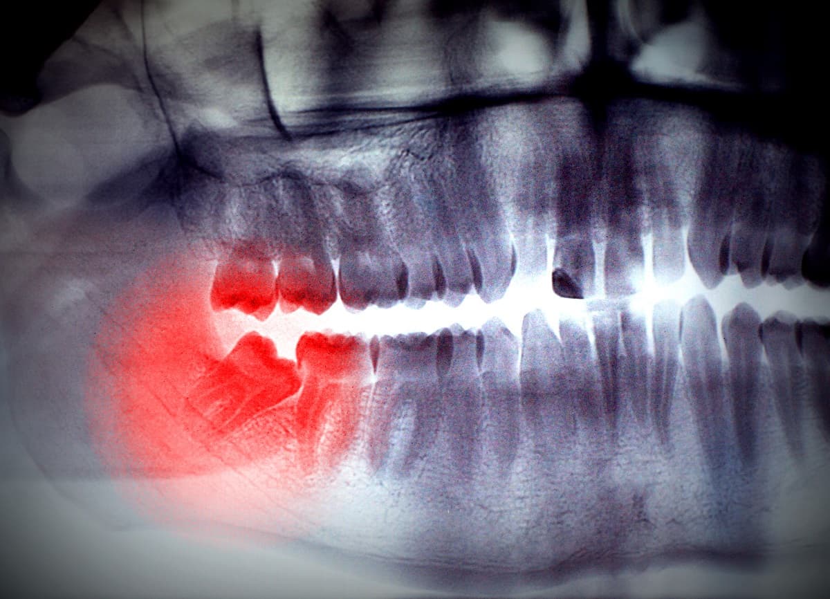 When Is the Right Time for Wisdom Teeth Removal?