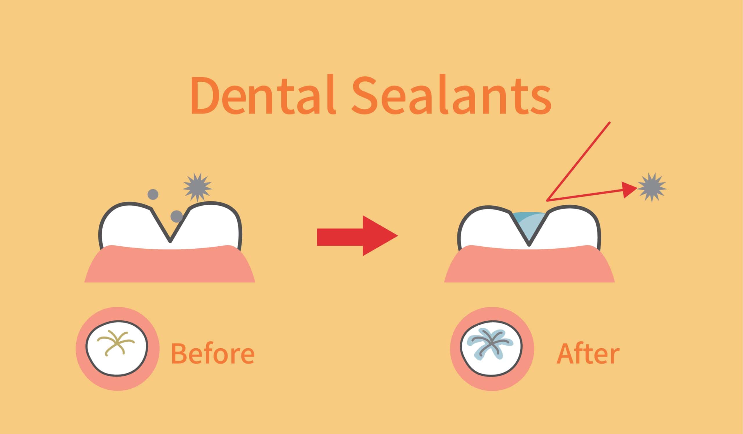 The Benefits of Dental Sealants for Children and Adults